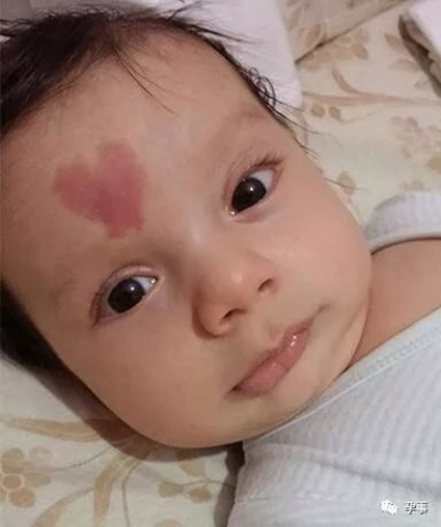 (天使之吻胎记微信群)天使之吻胎记会自然消失吗？如何有效去除这种瑕疵？